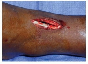 Illustration 5 for Distal Tibial Osteotomy: Fixing Varus & Valgus Ankle Alignment