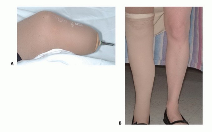 Illustration 20 for Below-Knee Amputation: Maximize Your Below-Knee Recovery & Function