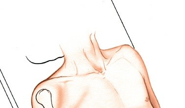 Illustration 71 for Mastering the Approach to the Distal Humerus: Safety & Skills