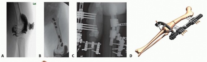 Illustration 50 for Treatment for Congenital Femoral Deficiency: What You Need to Know