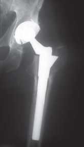 Illustration 45 for S-ROM: Inside the Technique of Modular Implant Design