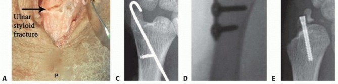 Illustration 22 for Galeazzi DRUJ Stabilization: Unlocking Stability with Smooth Stainless Steel