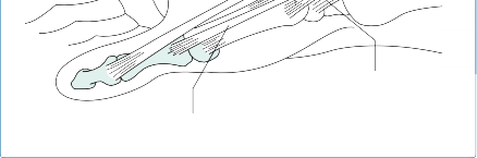 صورة طبية: جراحة الرسغ المتقدمة: دليل شامل لخيارات العلاج والتعافي مع الأستاذ الدكتور محمد هطيف في صنعاء