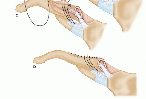 Illustration 28 for Optimizing SC Dislocation Repair After Medial Clavicle Resection