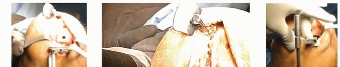 صورة طبية: استبدال مفصل الركبة الجزئي: حل متقدم لآلام الركبة المستمرة مع الأستاذ الدكتور محمد هطيف