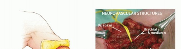 Illustration 16 for Above-Elbow & Below-Elbow Amputations: When & Why They're Needed
