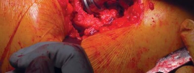 Illustration 39 for Unlock better THA: The technique of short stem for less invasiveness