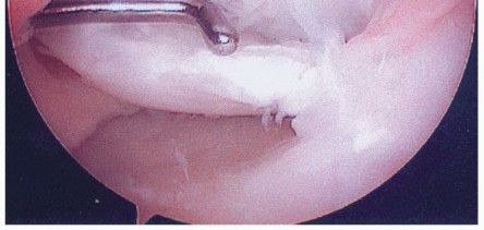 Illustration 21 for Dissecans of the Knee: What's the Difference – OCD vs. AVN?