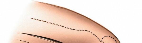 Illustration 141 for Mastering Knee Approaches: Spotlight on Superficial Medial Ligament