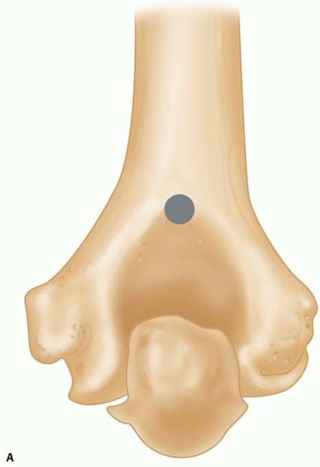 Illustration 23 for Distal Humeral Fractures: When Is Elbow Replacement the Best Option?