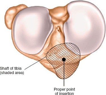 Illustration 125 for Surgical Access: Mastering the Tibia's Surface & Fibula Approaches