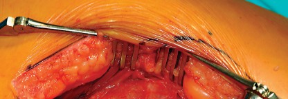 Illustration 33 for Direct Lateral Hip: Optimize Exposure with Sharp Curved Hohmann