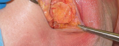 Illustration 6 for Minimally Invasive THA: Navigating Techniques, Benefits & Pitfalls