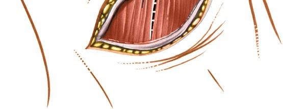 Illustration 6 for Mastering the Anterior Cervical Approach: Longus Colli Muscle Insights