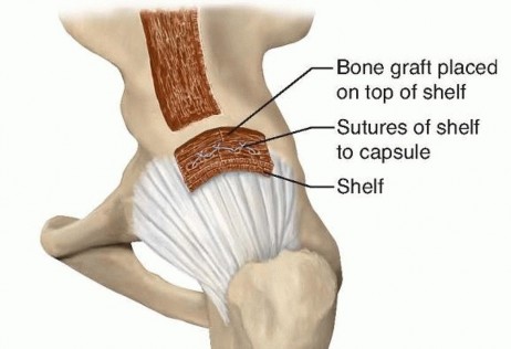 Illustration 11 for Labral Support Shelf Procedure: Preventing Perthes Deformity