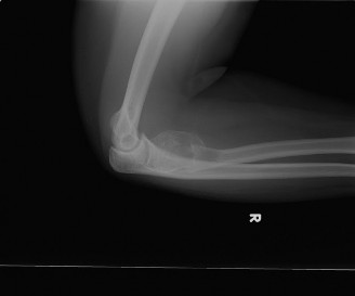 Challenging Oncology Cases: Aneurysmal Bone Cyst Diagnosis