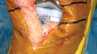 صورة طبية: استبدال مفصل الركبة بالحد الأدنى من التدخل الجراحي: ألم أقل وتعافٍ أسرع مع النهج شبه الرضفي الإنسي