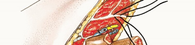 Illustration 15 for Below-Knee Amputation: Maximize Your Below-Knee Recovery & Function