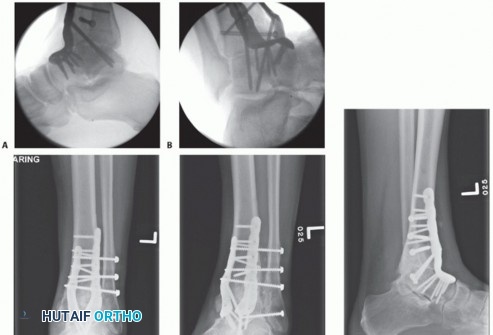 Illustration 31 for Optimize Pain Management with Proximal Ring Block for Ankle Arthrodesis