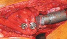 Illustration 37 for Advanced Arthroplasty for Malignant Lesions: Reclaim Your Mobility