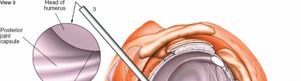 Illustration 230 for Essential Guide: Mastering Every Approach to the Shoulder