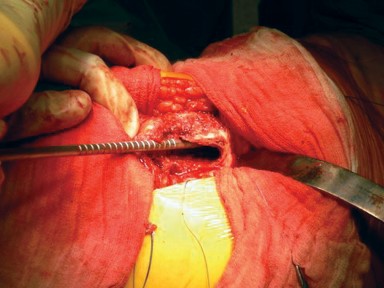 Illustration 15 for Cemented Femoral Stem Figures: Surgical Anatomy & Placement