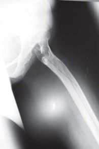 Illustration 18 for Successful Total Hip Replacement in Developmental Dysplasia
