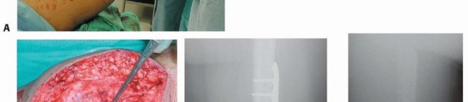 Illustration 62 for Repairing Distal Femur Fractures: Open Reduction & Internal Fixation