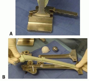 Illustration 9 for Resection Arthroplasty & Spacers: Optimizing Time of Reimplantation