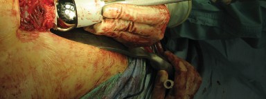 Illustration 64 for Figure Hip Resurfacing: Who Benefits and Who Should Avoid It?