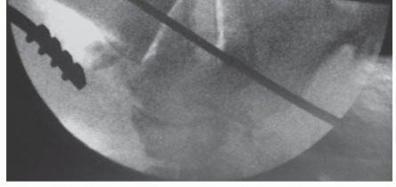 Illustration 43 for Unlock Stability: Medullary Nail Fixation for Tibiotalocalcaneal Arthrodesis