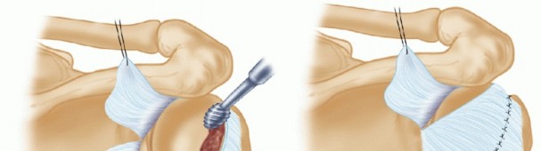 Illustration 18 for Finally Treat Recurrent Posterior Instability of the Shoulder