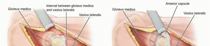 Illustration 20 for Septic Hip in Children: Mastering Anterior Drainage for Optimal Recovery