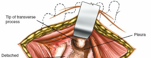 Illustration 301 for Approach to the Lumbar Spine: Mastering Techniques & Anatomy