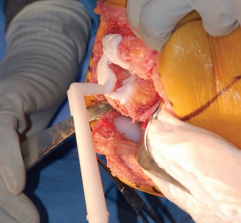 Illustration 57 for Mastering Gap Balancing in Revision TKA: Avoid Common Pitfalls