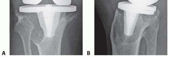 Illustration 2 for Bone Loss Bone Grafting for Challenging Tibial Defects