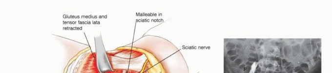 Illustration 25 for Posterior Flap Hemipelvectomy: Mastering Techniques for Optimal Outcomes