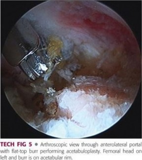 Illustration 138 for Precision Hip Arthroscopy: Unlock Access to the Peripheral Compartment