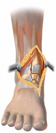 Illustration 29 for Optimizing ORIF for Tibial Plafond Fractures: A Modern Approach
