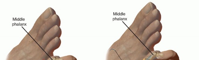 Illustration 26 for Toe Deformity Pain? Rebalance Flexor to Extensor for Relief