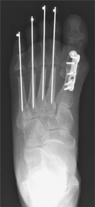 Illustration 2 for Painful Foot Deformities? Explore Arthrodesis Lesser Toe Solutions