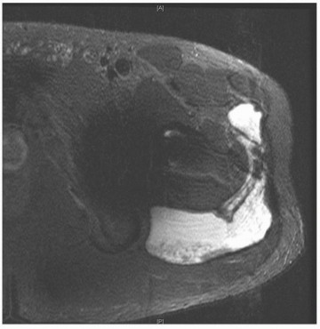 Illustration 16 for Mastering Revision THA: Strategies for Adverse Local Tissue Challenges