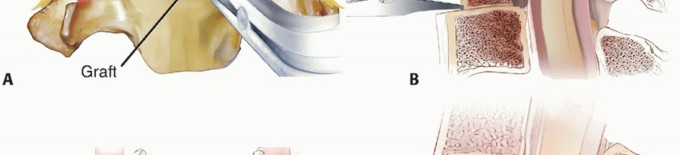 Illustration 32 for How ACDF Clears Your Posterior Disc Space for Lasting Relief