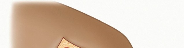 Illustration 23 for Mastering the Treatment of Recurrent Posterior Shoulder Instability