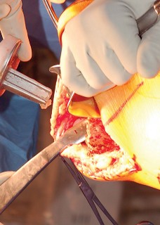 Illustration 18 for Mastering Gap Balancing in Revision TKA: Avoid Common Pitfalls