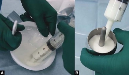 Illustration 97 for Birmingham Hip Resurfacing Designer's Technique for Active Lives