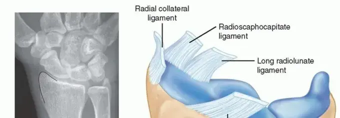 وداعاً لألم الرسغ: كل ما تحتاج معرفته عن استئصال النتوء الإبري الكعبري وعلاجه في اليمن