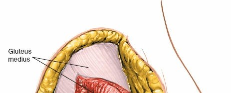Illustration 8 for Simple & Safe Posterior Approach to the Sacroiliac: Key Techniques