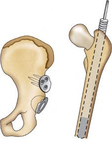 Illustration 74 for Successful Total Hip Replacement in Developmental Dysplasia
