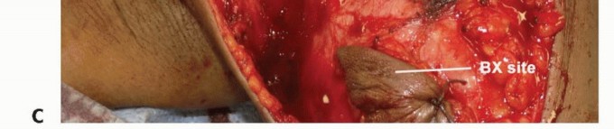 Illustration 26 for Limb-Sparing Resections Around the Shoulder: Optimizing Outcomes